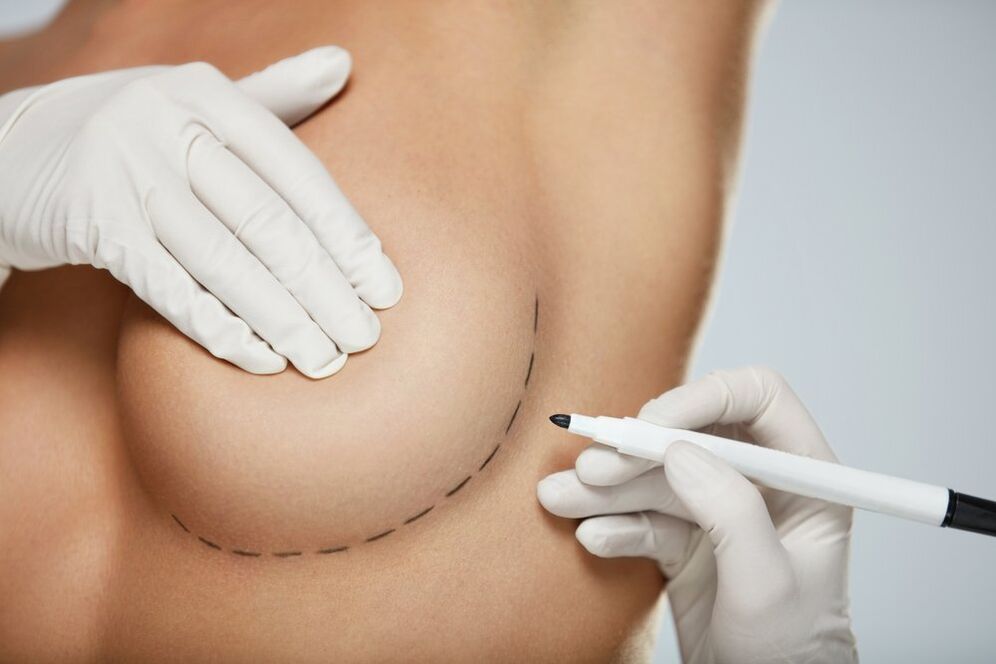 periareolar breast mammoplasty
