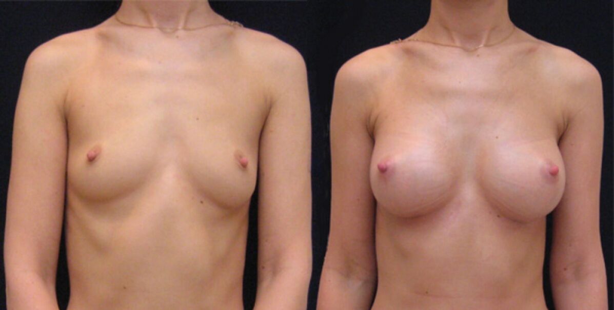 breast before and after endoscopic enlargement
