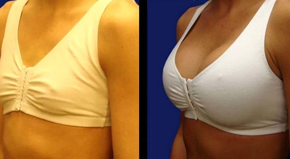 Breast photo before and after surgery