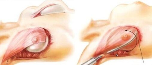 How is the breast enlargement surgery performed