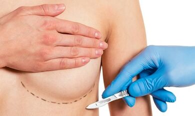 Submamor Access to breast enlargement with implants