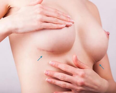 Breast enlargement with implants