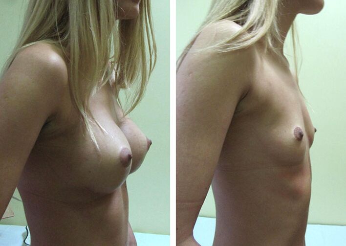 Result of breast augmentation with implants