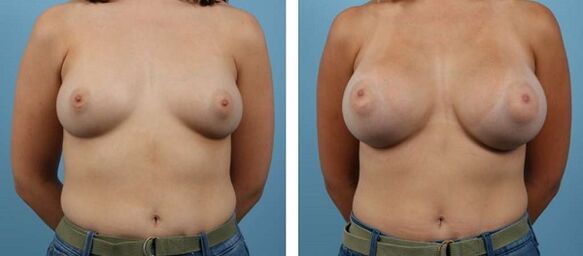before and after breast augmentation photos