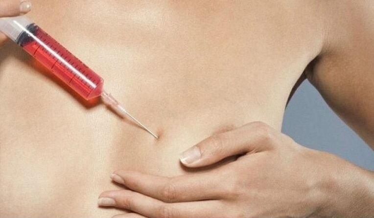 Breast augmentation with hyaluronic acid injections
