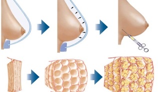 how to perform the procedure for breast augmentation with fat