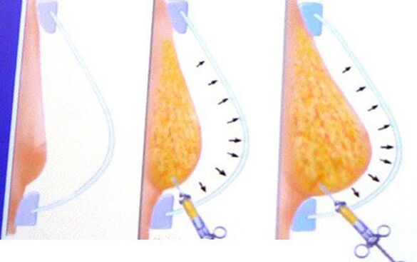 breast augmentation with fat